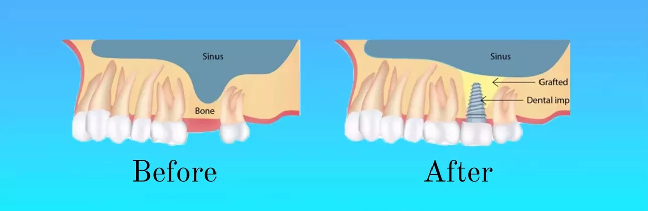 Sinüs Lifting Nedir? İmplant Tedavisinde Sinüs Lifting